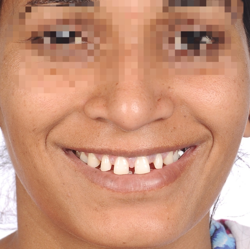 Before Treatment - Natural Smile